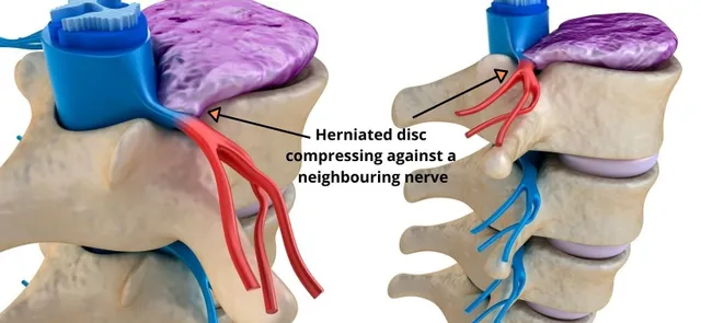 Back Pain, Intervertebral Disc and Annular Tear